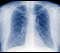 X-ray image of lungs