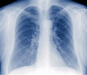 x-ray of lungs