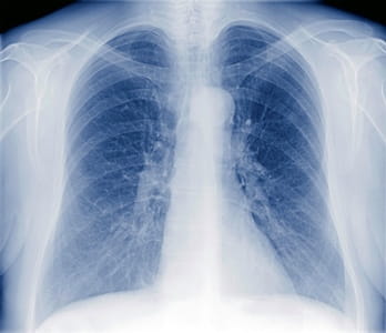 X-ray image of lungs