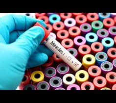 A blood vial is typed for measles. Doctors investigate a measles outbreak. 
