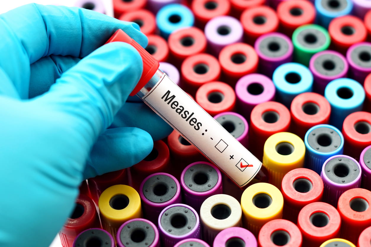 A blood vial is typed for measles. Doctors investigate a measles outbreak. 