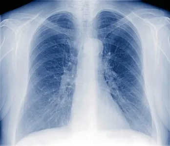 Update on the Denver Public Health and Aurora Hills Middle School Tuberculosis Contact Investigation
